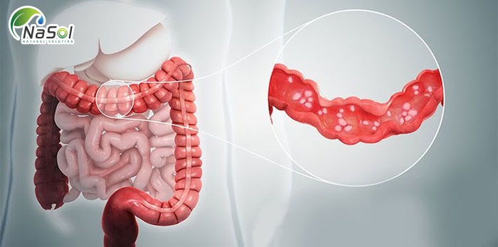 tác dụng điều trị viêm đại tràng của N-acetylglucosamin