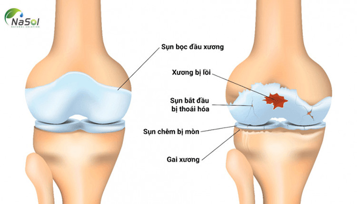 Bảo vệ sụn khớp của Proteoglycan từ sụn mũi cá hồi