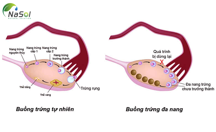 Buồng trứng đa nang với D-chiro-Inositol