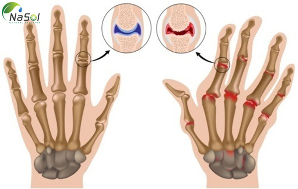 axit gamma linolenic viêm khớp dạng thấp