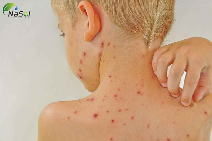 Chống dị ứng của bông cải xanh