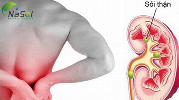 shatavari giúp điều trị sỏi thận