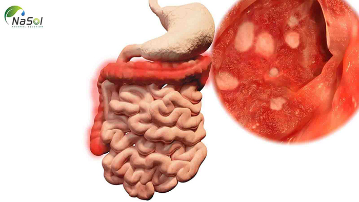 Tác dụng của Nhũ hương với viêm đại tràng