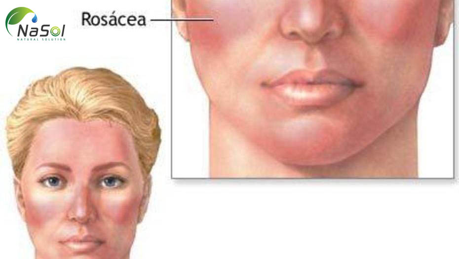 Thăm dò tác dụng trong điều trị bệnh ROSACEA