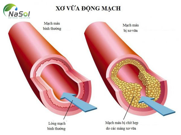 Chống chuyển hóa mỡ trong máu – Chống xơ vữa động mạch vành của chiết xuất tỏi