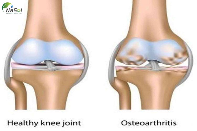 Tác dụng của Collagen với sụn