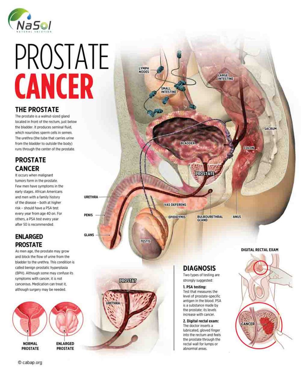 Giảm nguy cơ ung thư tuyến tiền liệt