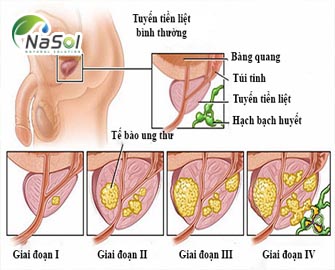Nghiên cứu tác dụng của cọ lùn saw palmetto với các bệnh tuyến tiền liệt  Nghiên cứu tác dụng của cọ lùn saw palmetto với các bệnh tuyến tiền liệt