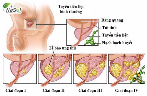 Các triệu chứng của phì đại tuyến tiền liệt